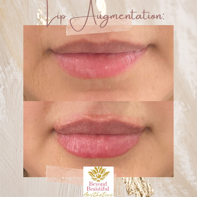 Lip Asymmetry Correction Expert Murray Hill NYC