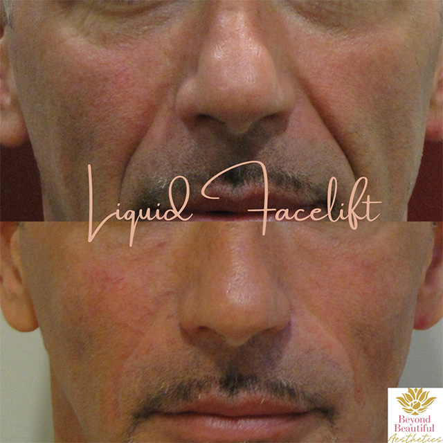 Liquid Facelist Specialist Murray Hill NYC