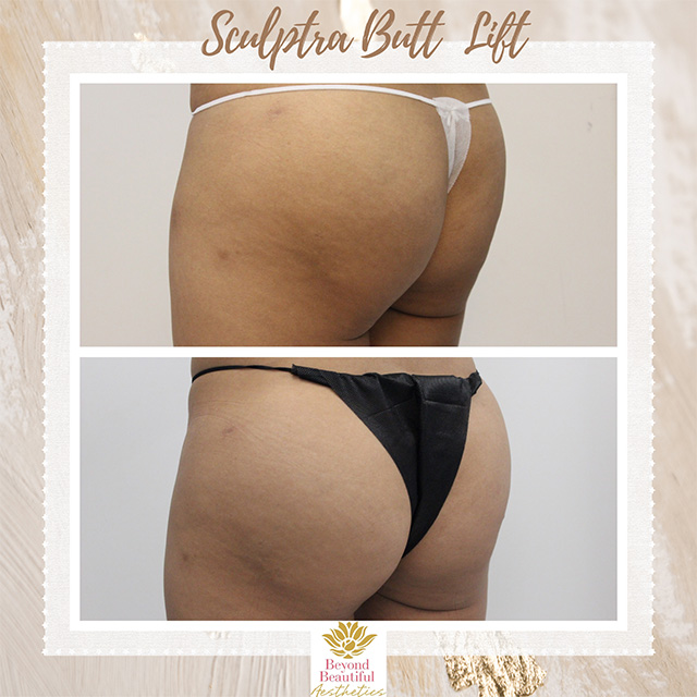 Sculptra Butt Lift Specialist Murray Hill NYC