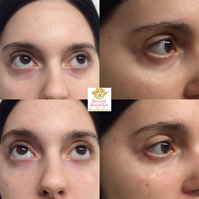 Under-eye Filler Expert Murray Hill NYC