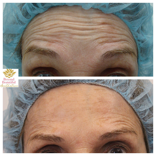 Forehead Lines Filler Specialist Murray Hill NYC